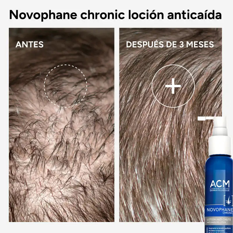 Acm Laboratoires Novophane Chronic Lotion anti-chute, 100 ml