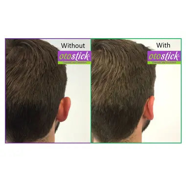 Otostick Aesthetic Ear Concealer pour peau normale