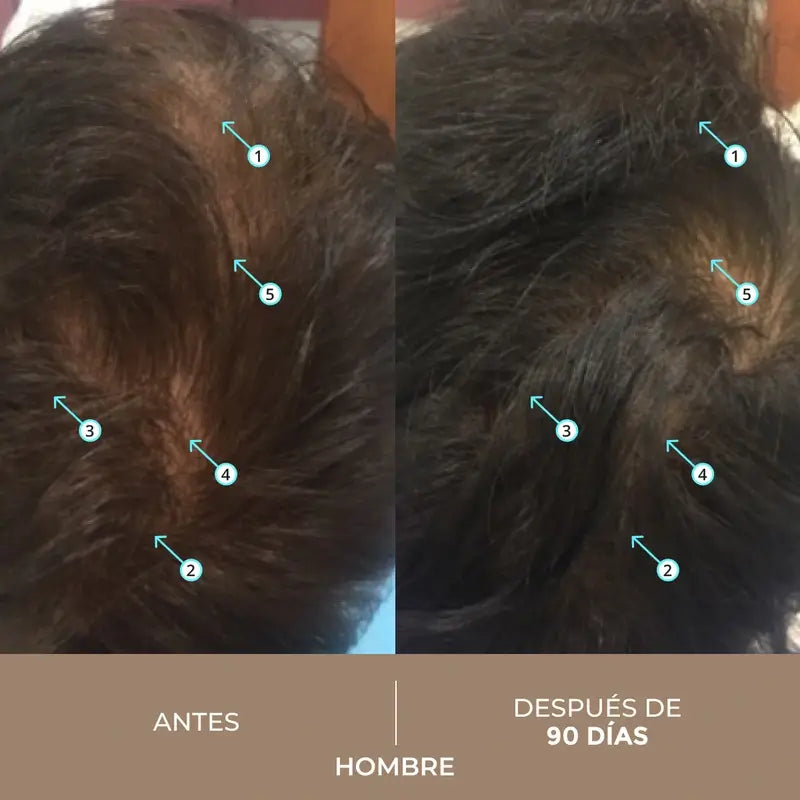 Ds Laboratories Spectral Lotion Dnc-N 3 Month Hair Loss Treatment with Nanoxidil® 5%, 180 ml