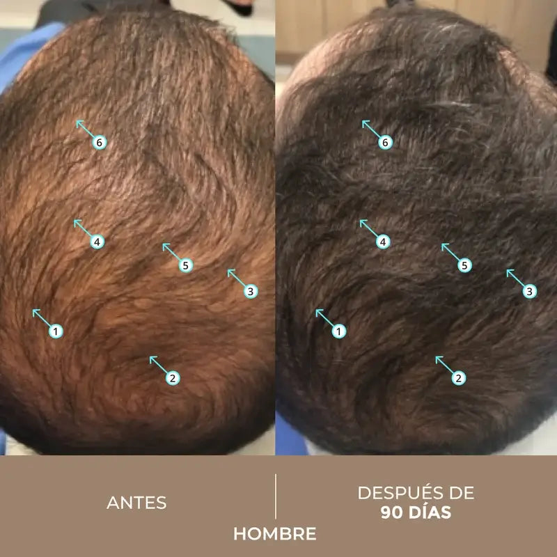 Ds Laboratories Spectral Lotion Dnc-N 3 Month Hair Loss Treatment with Nanoxidil® 5%, 180 ml