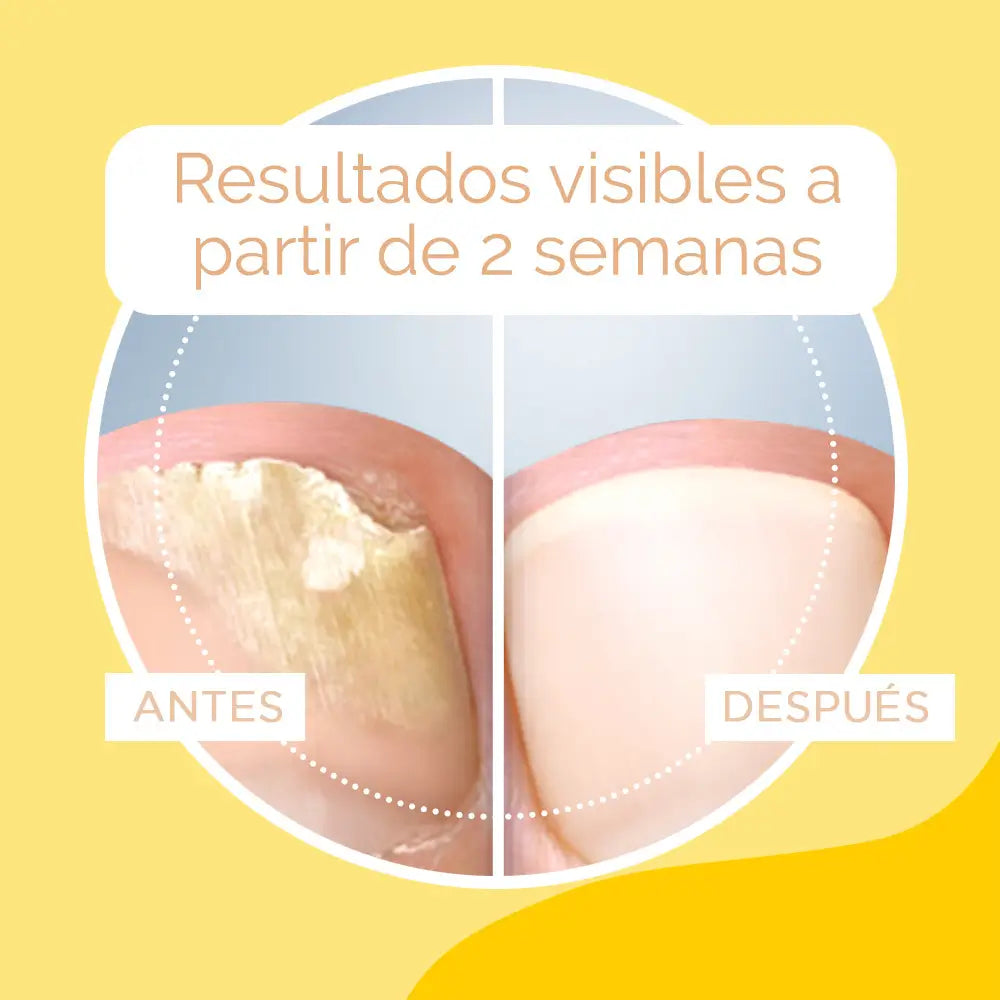 Traitement antifongique pour les ongles Scholl